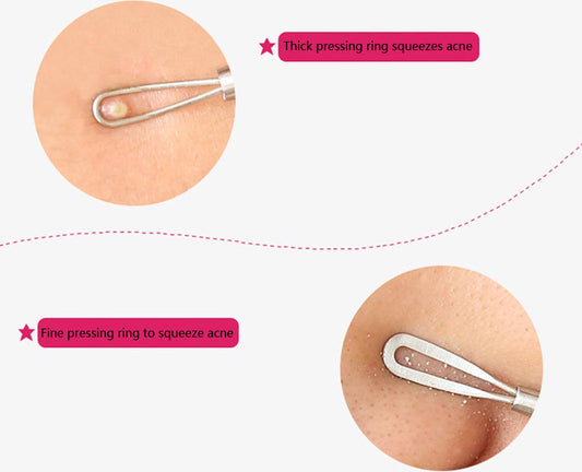 Comedone Spoon | Blackhead Remover | Acne Remover | Comedone Extractor | Blackhead Removal IRVS
